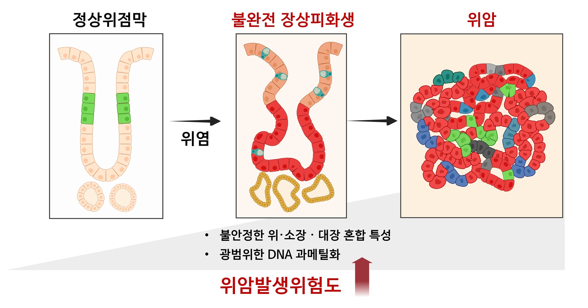 제주대 의과대, 불완전 장상피화생, 위암 전단계 입증... 의학계 ‘주목’